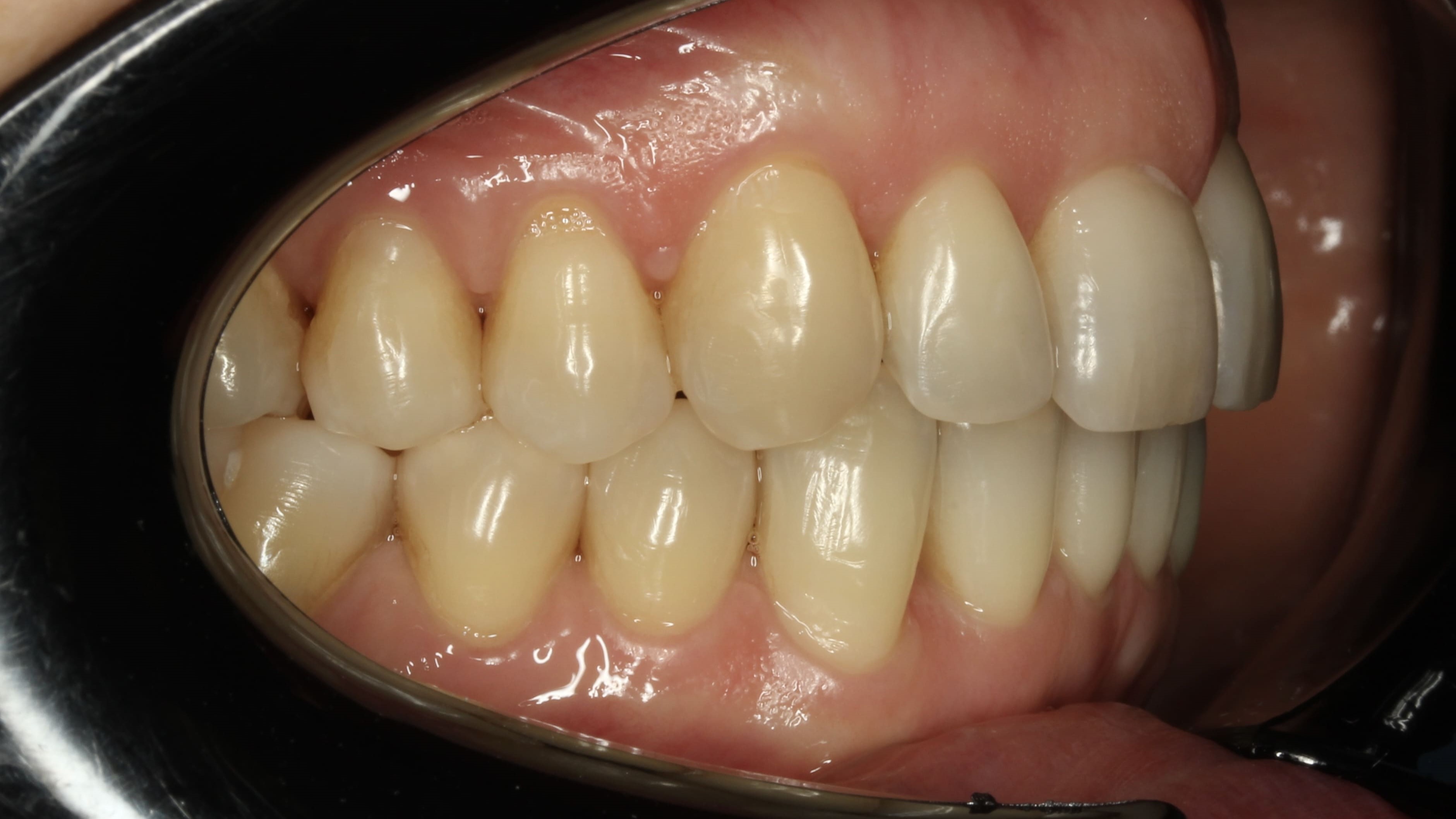 teeth before