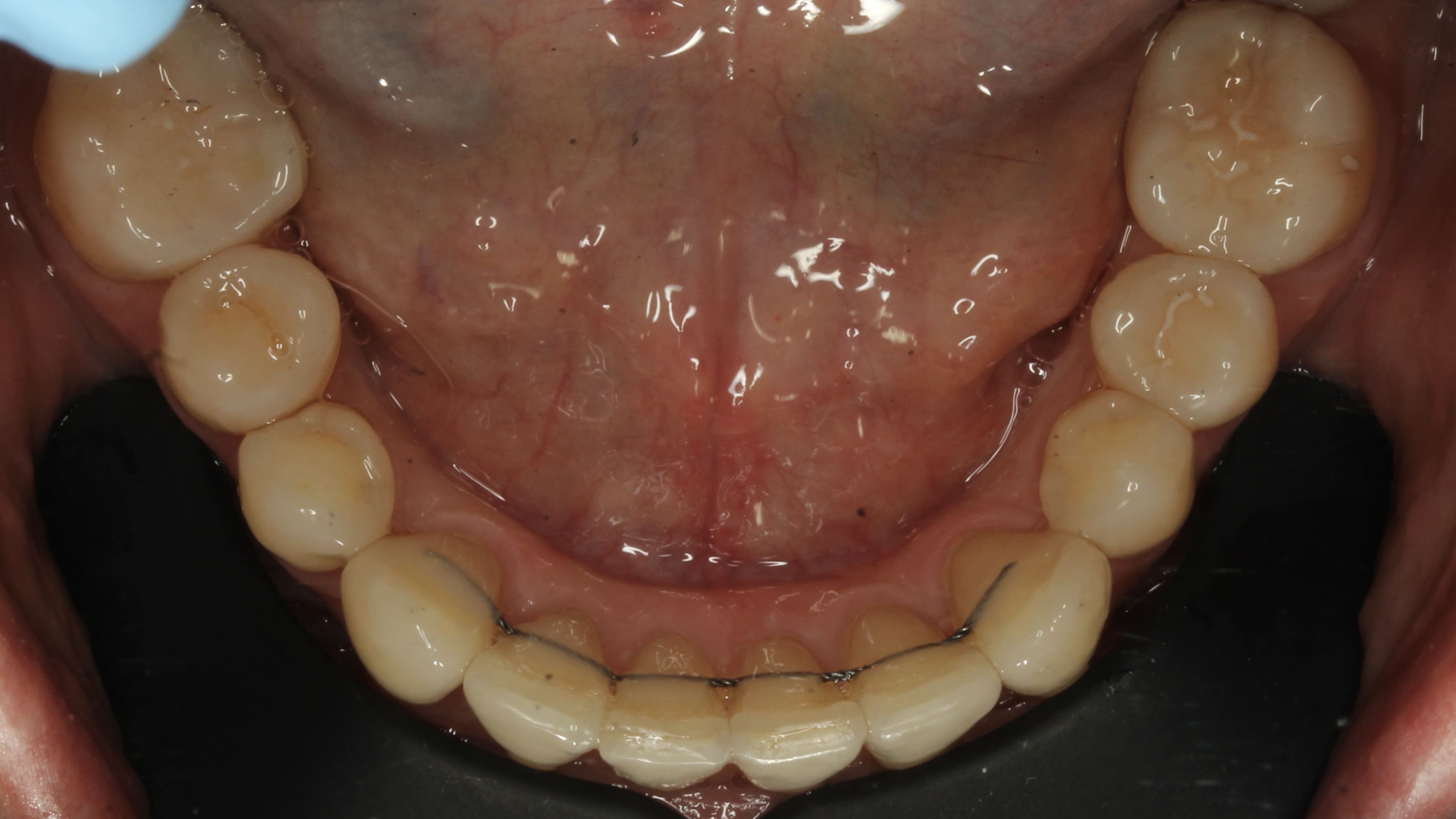 teeth before