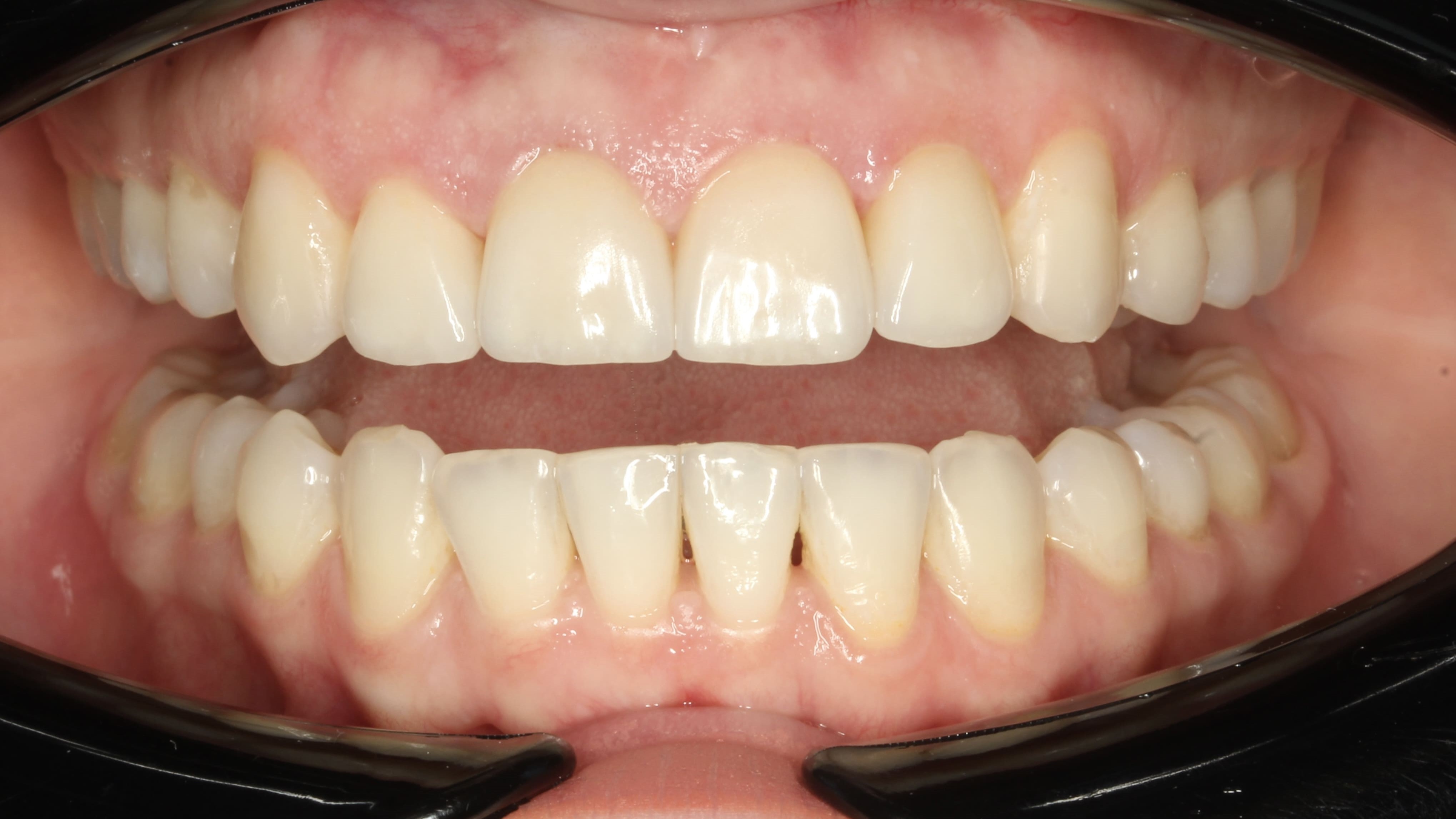 teeth before